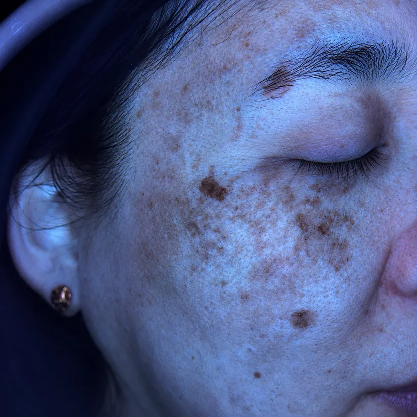 Skin analysis under UV light, pigment made visible